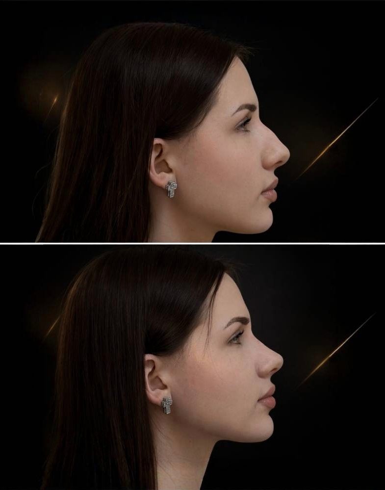 Ринопластика до и после