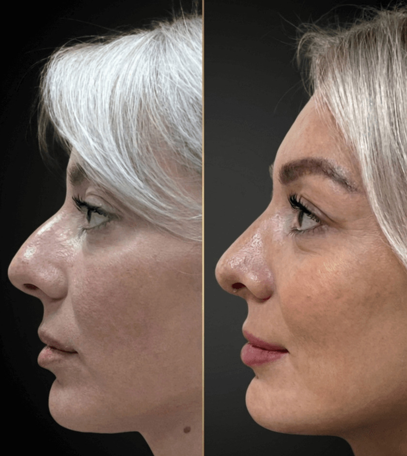 Риносептопластика до и после