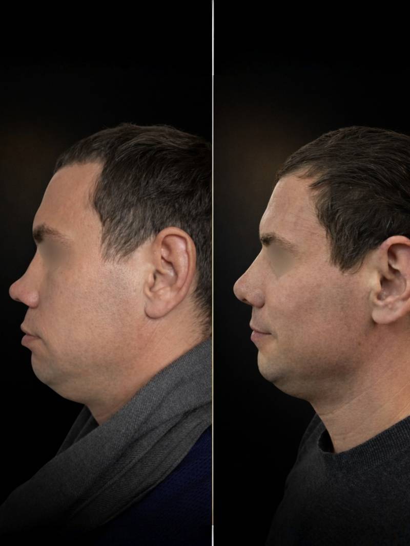 Вторичная ринопластика до и после